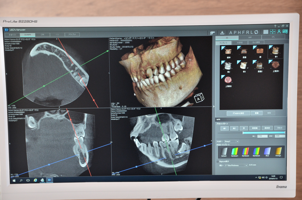 歯科用CTスキャン